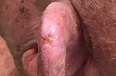 During MID Treatnent ear image