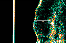 Mid Treatment Ultrasound image